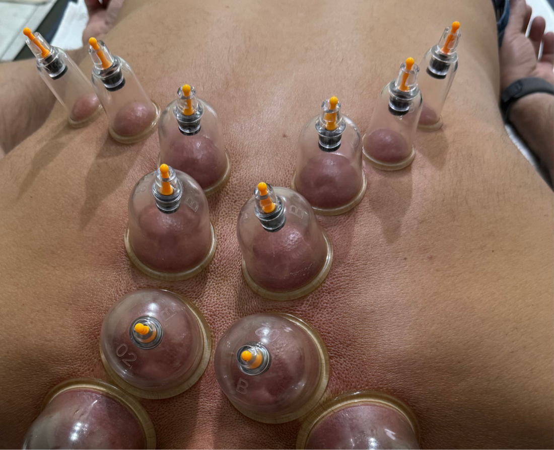 Técnica manual que usa ventosa sinop para criar vácuo na pele, sugando-a e promovendo a melhora da circulação sanguínea, alívio de dores musculares e tensões, esse serviço profisisonal você só encontra na Belle - Cabelo e Estética em Sinop-MT, o melhor preço com uma qualidade excepcional, profissionais com mais de 10 anos de experiência.