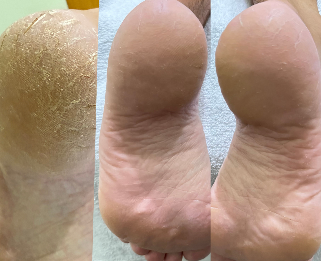 Tratamento e cuidados especiais com seus pés utilizando produtos de altíssima qualidade e técnicas aprimoradas ao longo de muitos anos de experiência, Esse serviço profisisonal você só encontra na Belle - Cabelo e Estética em Sinop-MT, o melhor preço com uma qualidade excepcional, profissionais com mais de 10 anos de experiência.